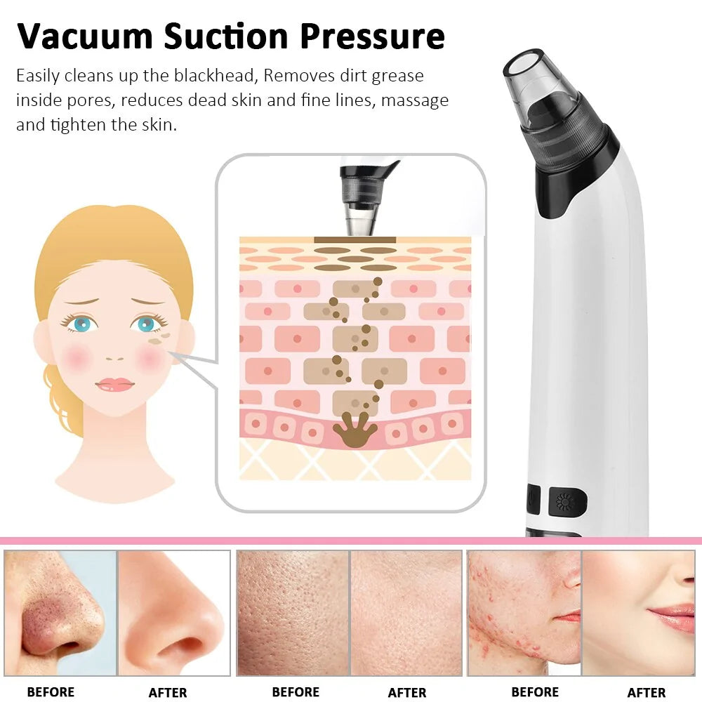 Blackhead Remover